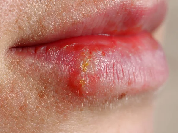 Herpes Lábio Uma Mulher — Fotografia de Stock