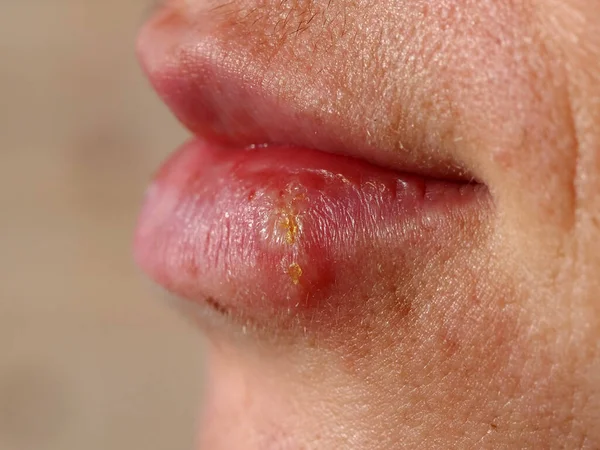 Herpes Lip Woman — Stock Photo, Image