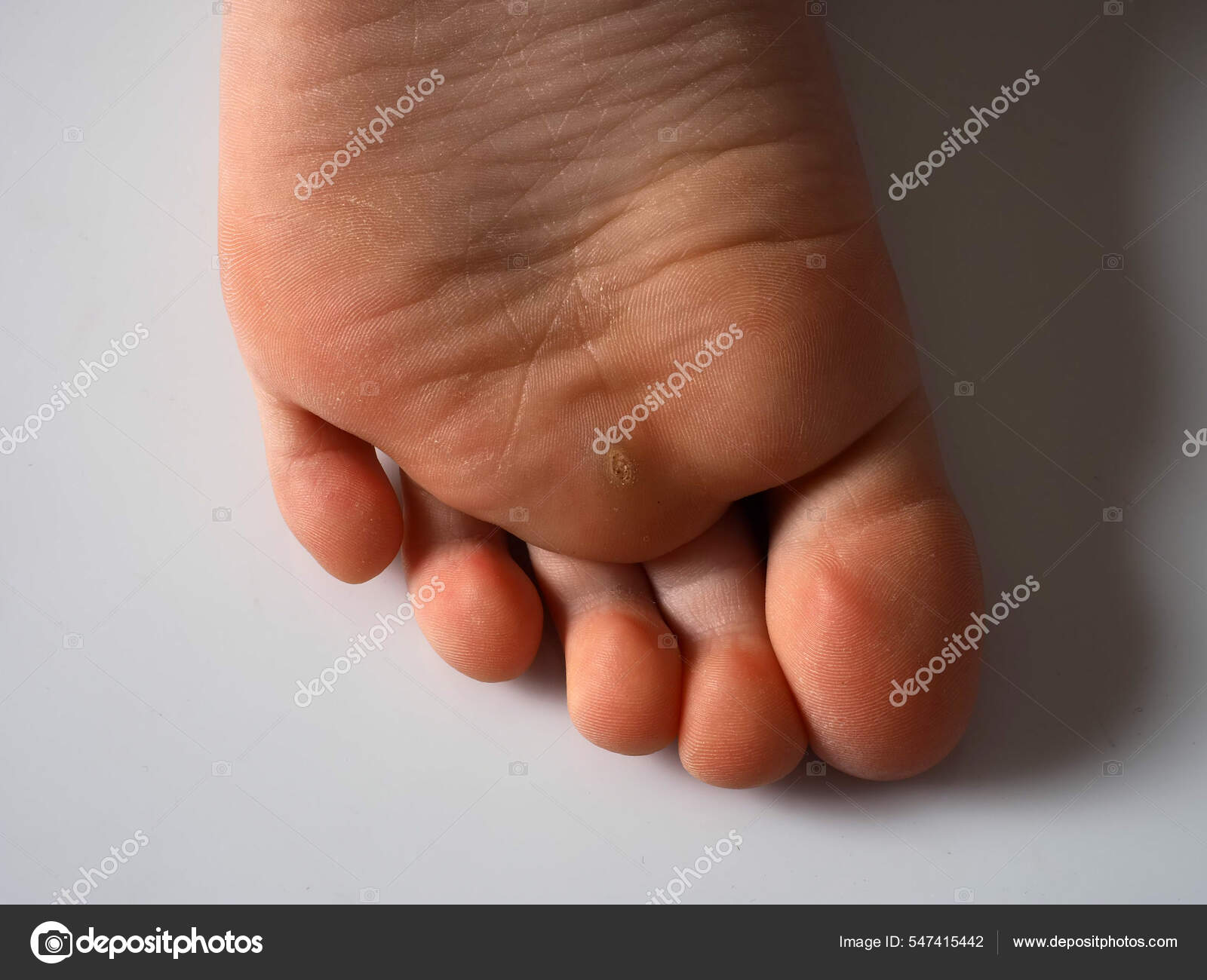 Bottom Of Corn On Foot Turned Black Callus Sole Child's Foot
