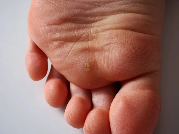 Callus Sole Child Foot — Stock Photo, Image
