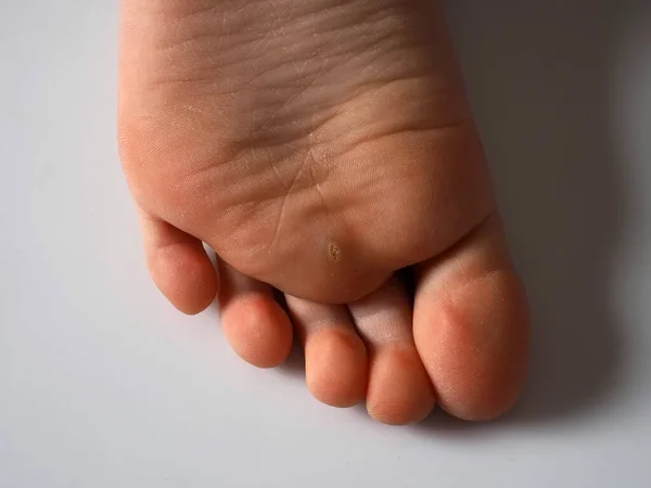 Callus Sole Child Foot — Stock Photo, Image