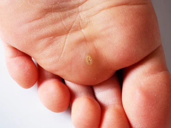 Callus Sole Child Foot — Stock Photo, Image