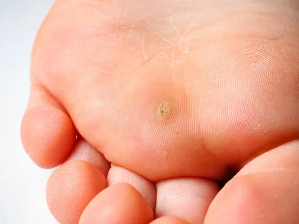 Callus Sole Child Foot — Stock Photo, Image