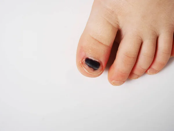 Bruise Child Toe Damaged Black Nail — Stock Photo, Image