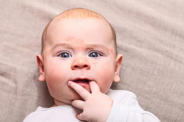 Porträtt Ett Nyfött Barn Med Ett Finger Munnen Ansiktet Allergi — Stockfoto