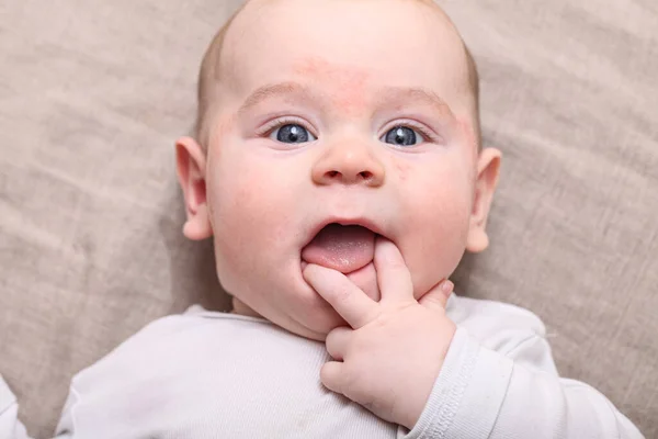 Retrato Bebê Recém Nascido Com Dedo Boca Sua Alergia Facial — Fotografia de Stock