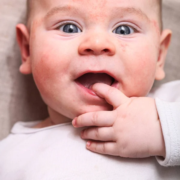 Retrato Bebê Recém Nascido Com Dedo Boca Sua Alergia Facial — Fotografia de Stock