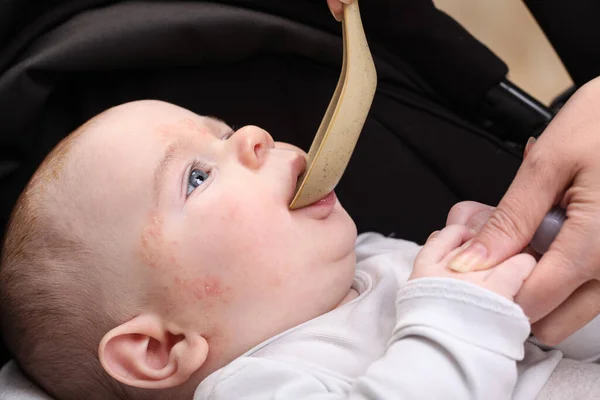 Mamá Una Cuchara Medicamentos Bebé Recién Nacido Dermatitis Alérgica Cara —  Fotos de Stock