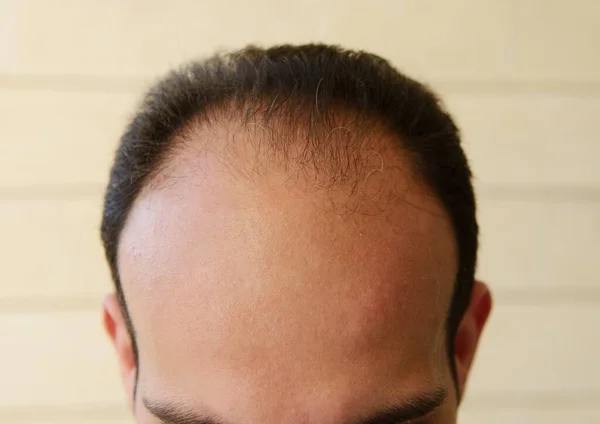 髪を失った男 — ストック写真