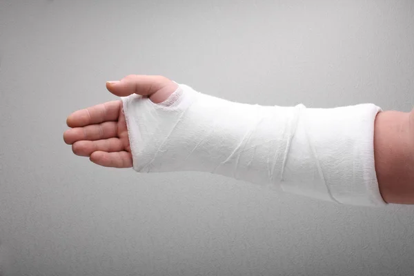 Gebrochener Armknochen im Gips — Stockfoto