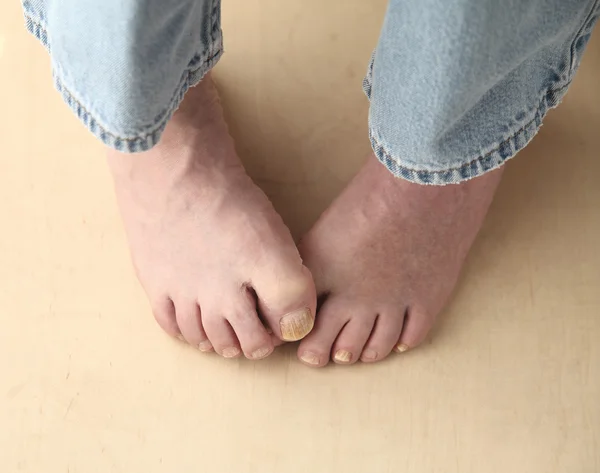 L'homme essaie de cacher son champignon ongle du pied — Photo