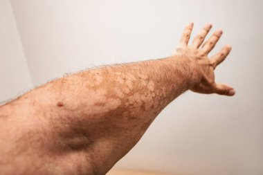 A man hand with a fungal dermatological skin disease. Symptoms of severe scratching and exfoliation of the epidermis