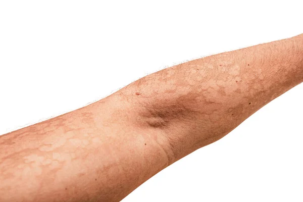 Isolated Man Hand Fungal Dermatological Skin Disease Symptoms Severe Scratching — kuvapankkivalokuva