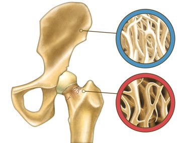 Osteoporosis clipart