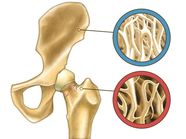 Osteoporose — Fotografia de Stock