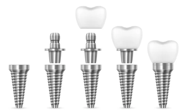 Metallo Umano Dente Impianto Vettore Illustrazione Isolato Sfondo Bianco — Vettoriale Stock