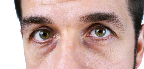 Homem com olhos muito cansados — Fotografia de Stock