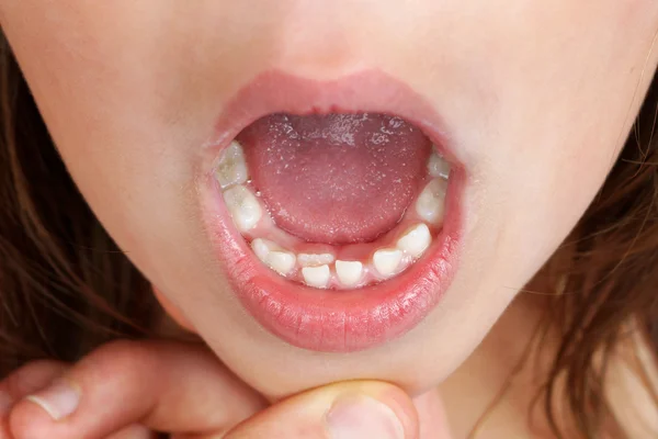 Niño con doble fila de dientes — Foto de Stock