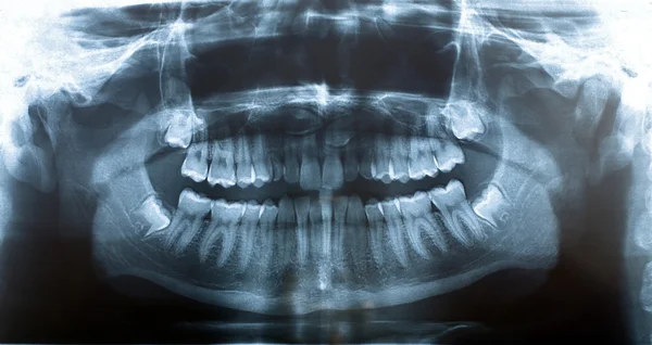 Imagen mandíbula de rayos X — Foto de Stock