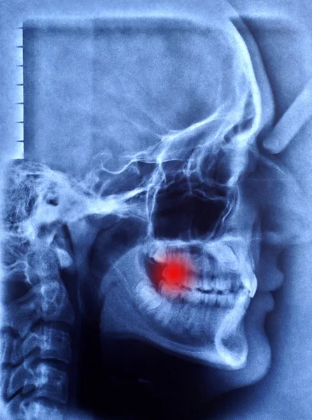 Bild Röntgenbild menschlicher Schädel — Stockfoto