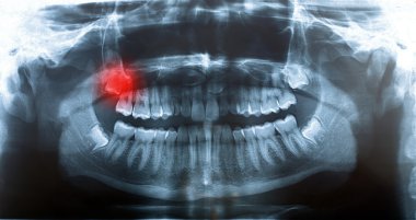 Resim x-ray insan kafatası