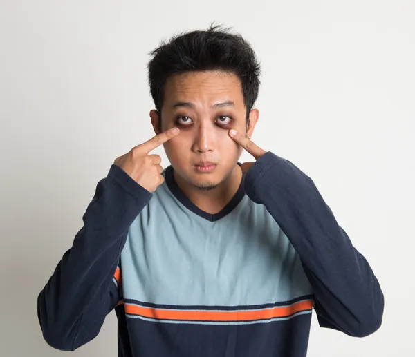 Dark eye circles — Stock Photo, Image