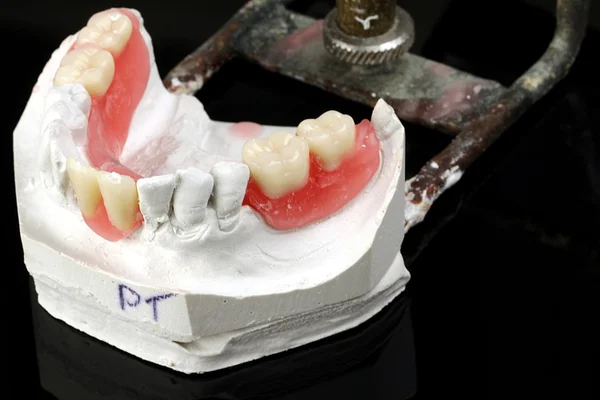 Dental prostheses — Stock Photo, Image