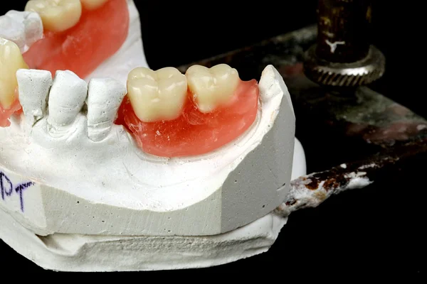 Dental prostheses — Stock Photo, Image