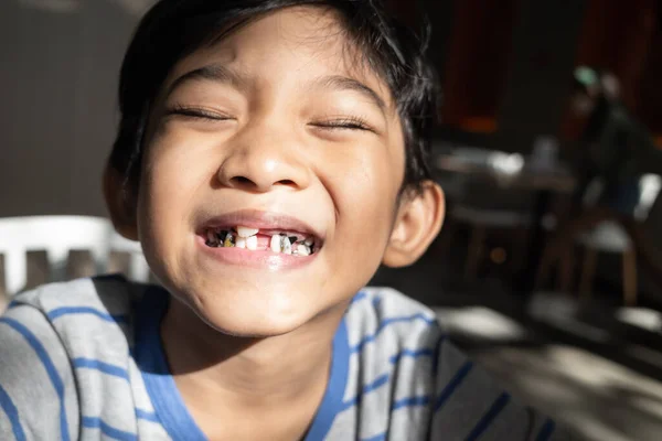 Kleine Zuidoost Aziatische Jongen Met Tandheelkundige Problemen Glimlachen Tonen Zijn — Stockfoto