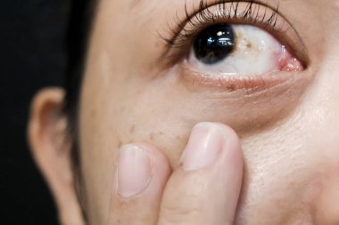 Sclera 'sında kahverengi lekeli bir kadın hemorajik konjonktivit olarak teşhis edildi.