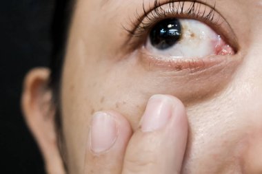 A Woman with Brown Spot on her Sclera Diagnosed as Hemorrhagic Conjunctivitis clipart