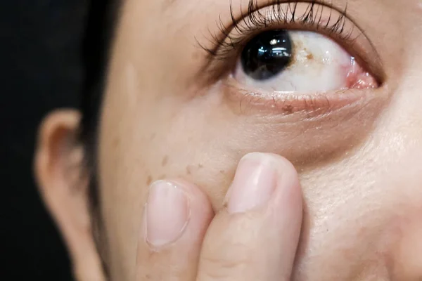 Eine Frau Mit Braunem Fleck Auf Ihrer Sklera Diagnostiziert Als — Stockfoto