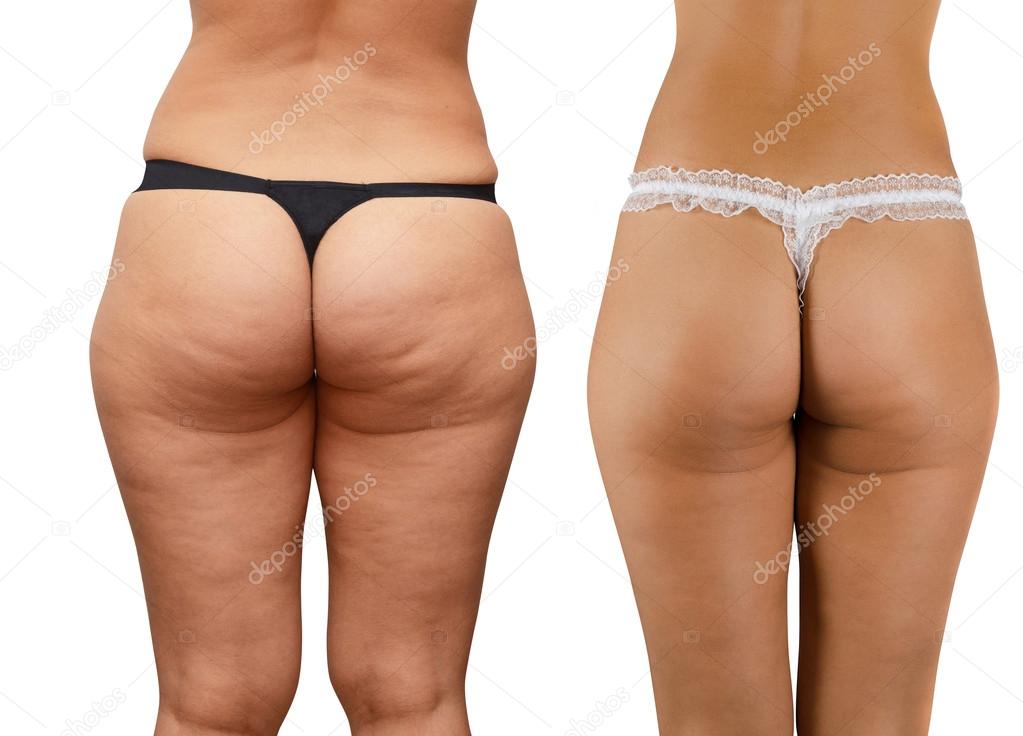 Cellulite buttocks