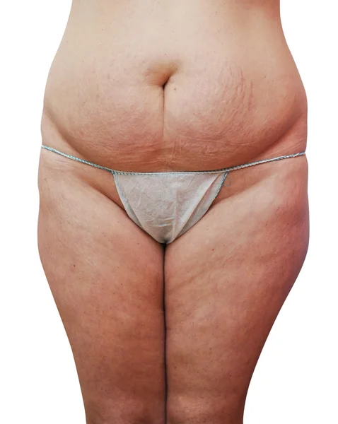 Ungesunde Frauen mit einer Cellulitis — Stockfoto