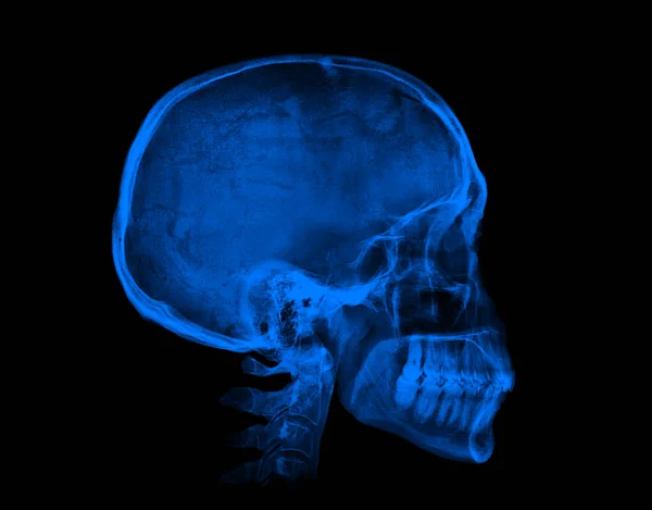 Crâne Humain Image Radiographique Bleue Isolée Sur Fond Noir — Photo