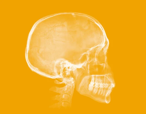 Человеческий Череп Рентгеновское Изображение Изолировано Желтом Фоне — стоковое фото
