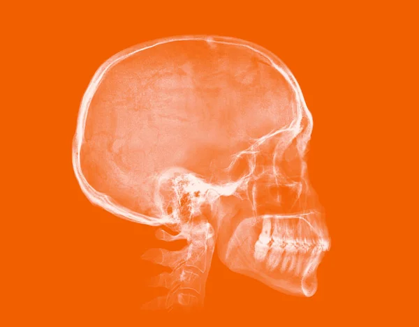 Calavera Humana Imagen Rayos Aislada Sobre Fondo Naranja — Foto de Stock