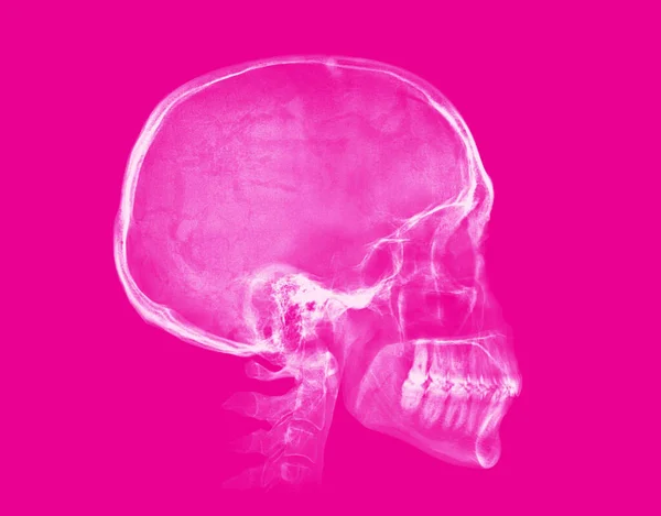 Человеческий Череп Рентгеновское Изображение Изолировано Розовом Фоне — стоковое фото