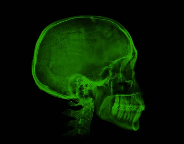 Menselijke Schedel Groene Röntgenfoto Geïsoleerd Zwarte Achtergrond — Stockfoto