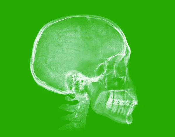 Human Skull Ray Image Isolated Green Background — Stockfoto