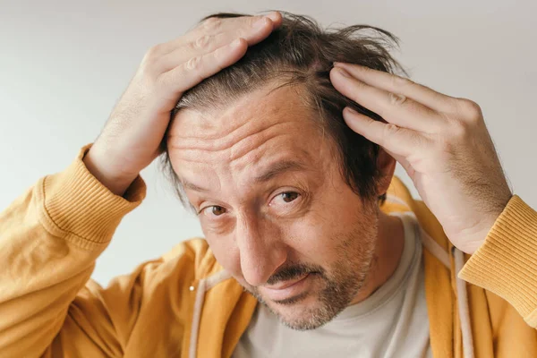 Håravfall Man Tittar Spegeln Orolig För Att Förlora Håret Pannan — Stockfoto