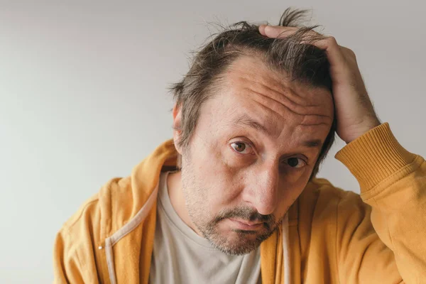 Pérdida Cabello Hombre Mirando Espejo Preocupado Por Perder Pelo Frente —  Fotos de Stock