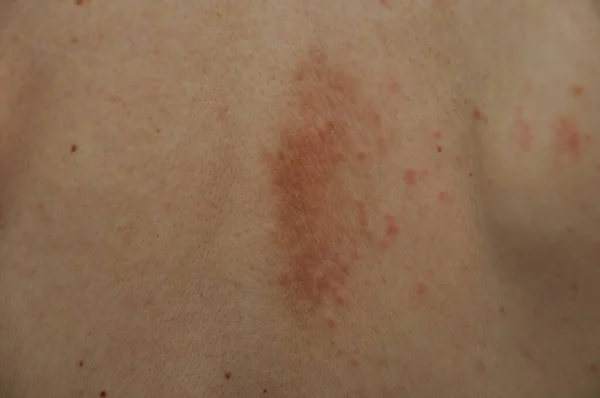 Brufoli Eczema Dorso — Foto Stock