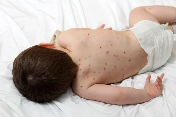 水痘和婴儿 — 图库照片