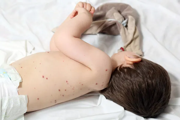 Chickenpox and baby Royalty Free Stock Photos