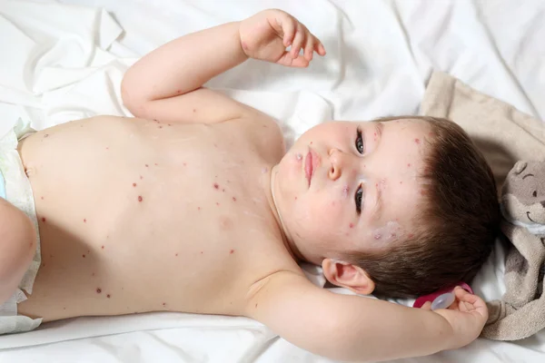 Chickenpox and baby Stock Picture