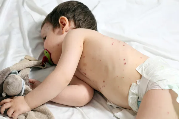 Chickenpox and baby — Stock Photo, Image