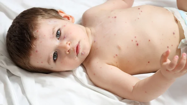 Chickenpox and baby Stock Image