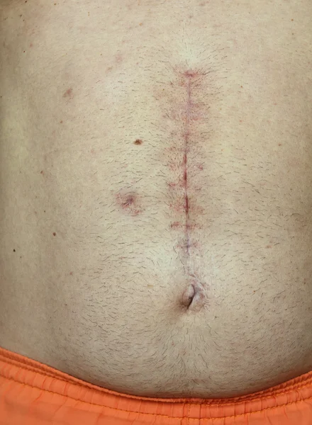 Scar from surgery — Stock Image Scar from surgery Royalty Free Stock Images