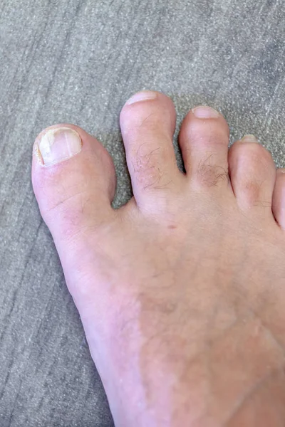 Uma Doença Dermatológica Que Afeta Unhas Dos Pés Causada Por — Fotografia de Stock